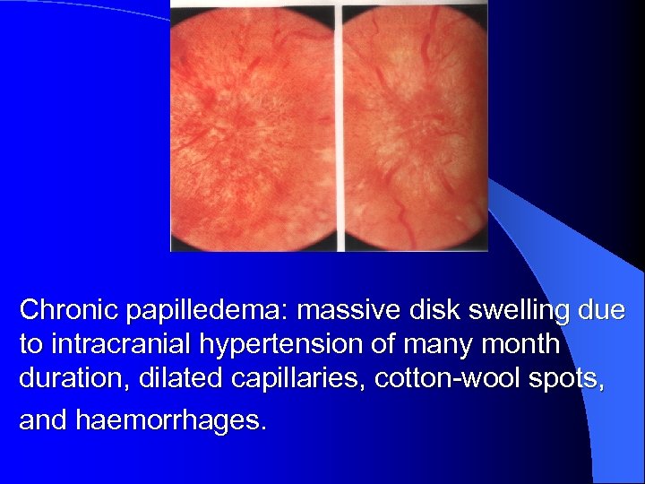 Chronic papilledema: massive disk swelling due to intracranial hypertension of many month duration, dilated