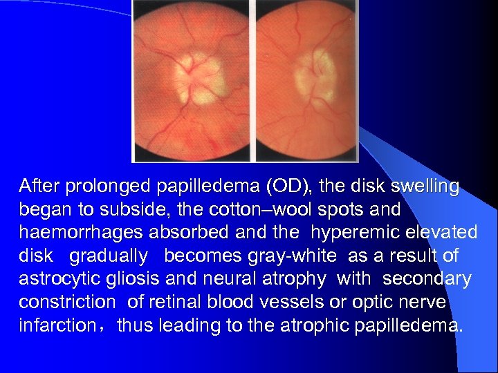 After prolonged papilledema (OD), the disk swelling began to subside, the cotton–wool spots and