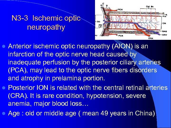 N 3 -3 Ischemic optic neuropathy Anterior ischemic optic neuropathy (AION) is an infarction