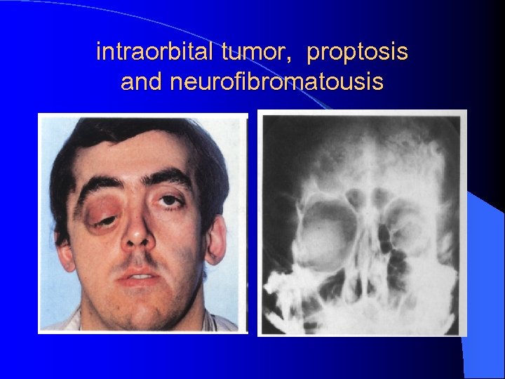 intraorbital tumor, proptosis and neurofibromatousis 