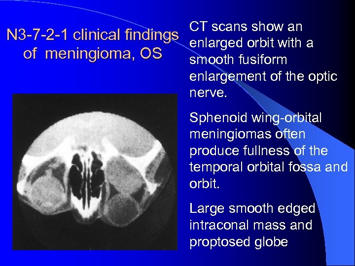 CT scans show an N 3 -7 -2 -1 clinical findings enlarged orbit with