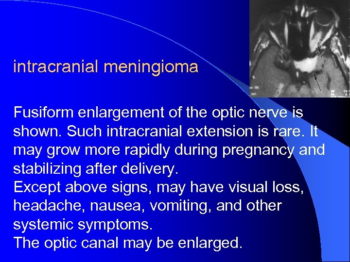 intracranial meningioma Fusiform enlargement of the optic nerve is shown. Such intracranial extension is