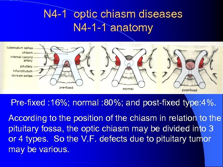 N 4 -1 optic chiasm diseases N 4 -1 -1 anatomy Pre-fixed : 16%;