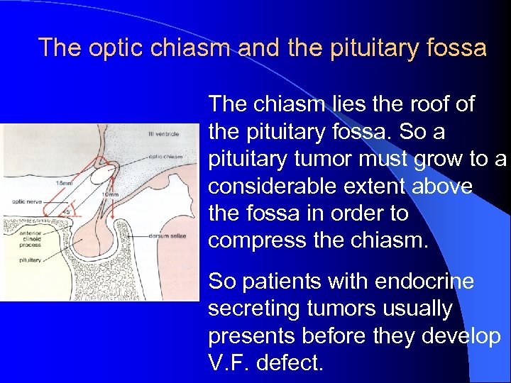 The optic chiasm and the pituitary fossa The chiasm lies the roof of the