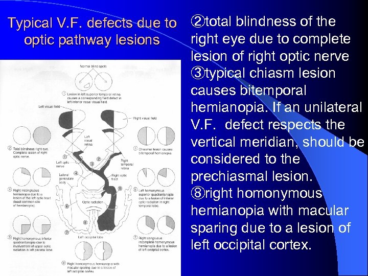 Typical V. F. defects due to ②total blindness of the right eye due to