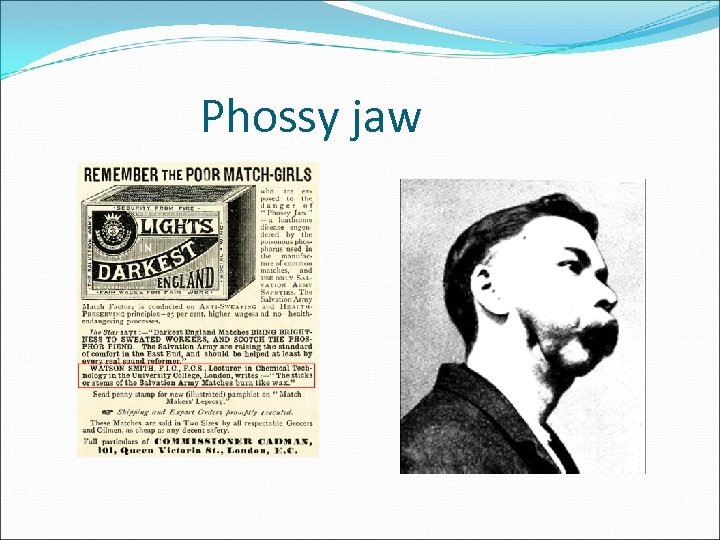 Phossy jaw 