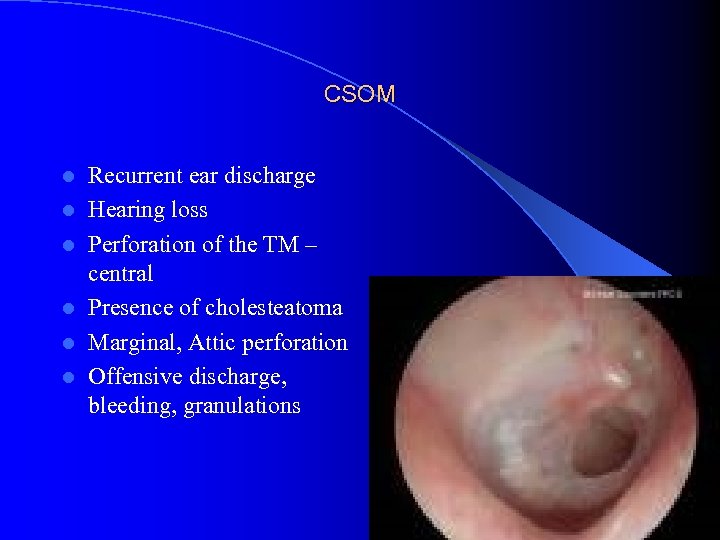 CSOM l l l Recurrent ear discharge Hearing loss Perforation of the TM –