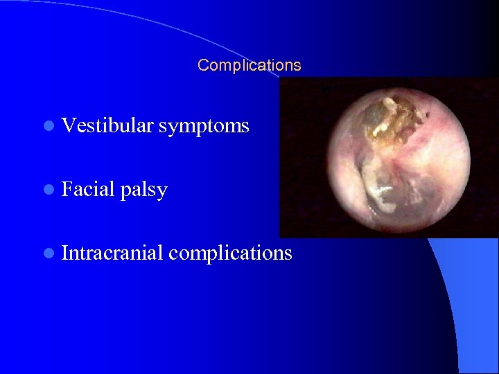 Complications l Vestibular l Facial symptoms palsy l Intracranial complications 