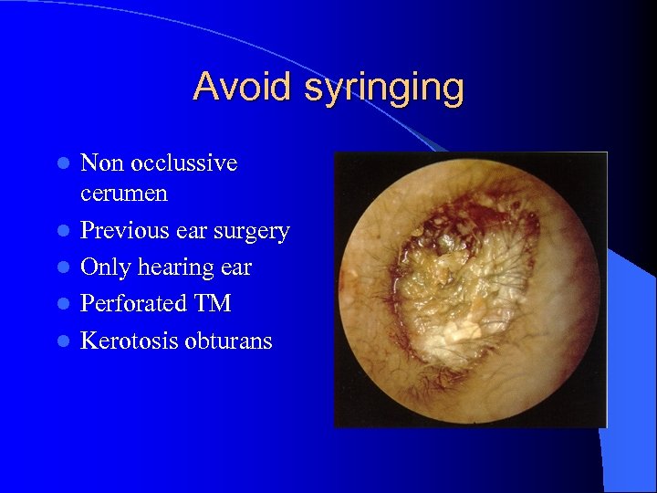 Avoid syringing l l l Non occlussive cerumen Previous ear surgery Only hearing ear