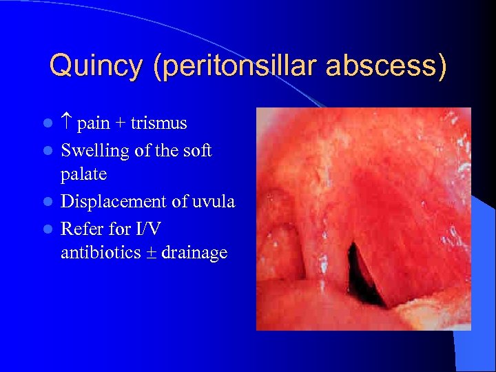 Quincy (peritonsillar abscess) pain + trismus l Swelling of the soft palate l Displacement