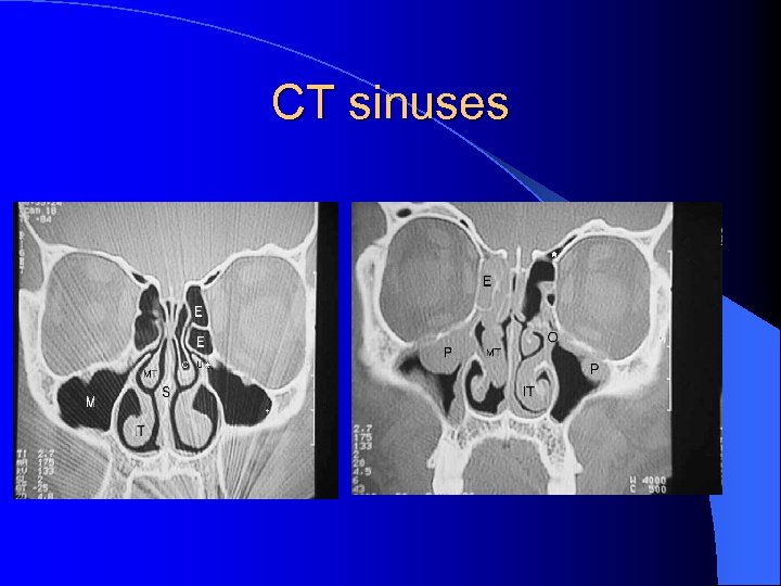 CT sinuses 