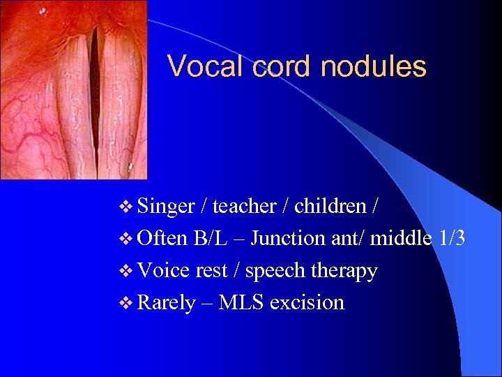 Vocal cord nodules v Singer / teacher / children / v Often B/L –