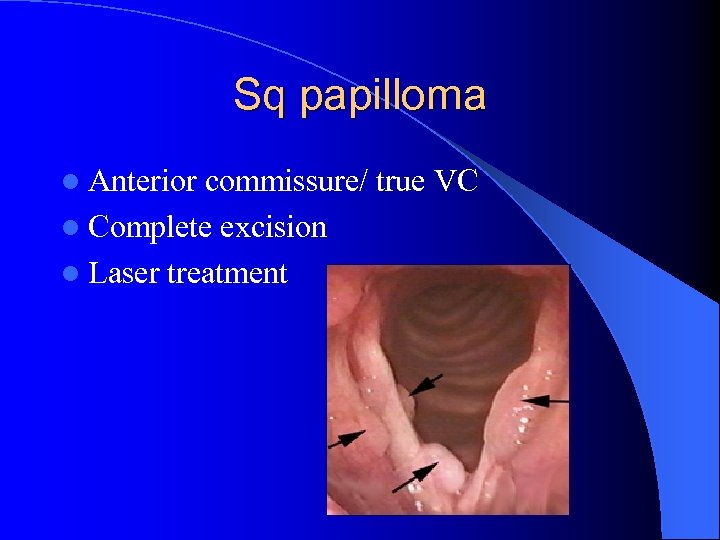 Sq papilloma l Anterior commissure/ true VC l Complete excision l Laser treatment 