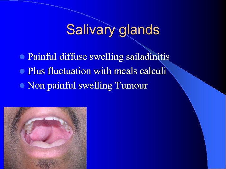 Salivary glands l Painful diffuse swelling sailadinitis l Plus fluctuation with meals calculi l