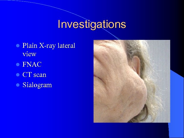 Investigations Plain X-ray lateral view l FNAC l CT scan l Sialogram l 