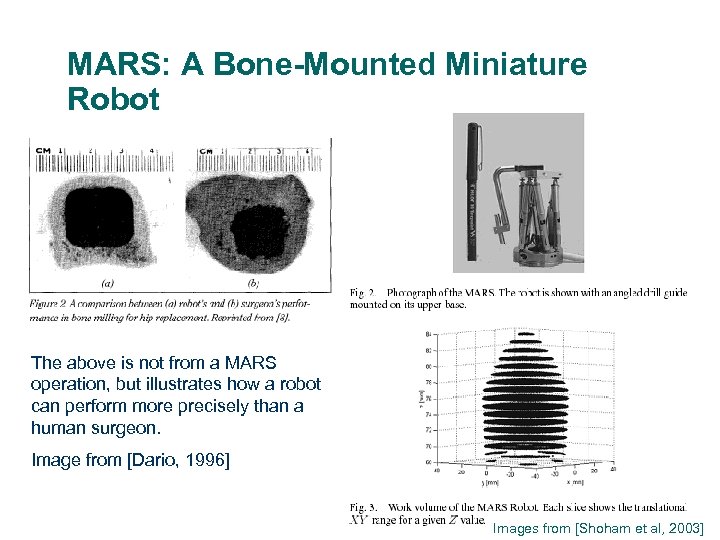 MARS: A Bone-Mounted Miniature Robot The above is not from a MARS operation, but