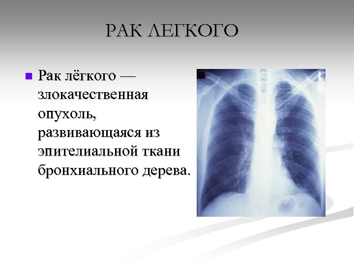 РАК ЛЕГКОГО n Рак лёгкого — злокачественная опухоль, развивающаяся из эпителиальной ткани бронхиального дерева.