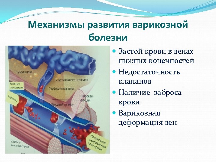 Механизм болезни. Механизм развития варикозного расширения вен. Варикозное расширение вен патогенез. Патогенез варикозной болезни. Механизм развития варикозной болезни.