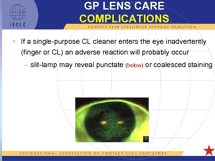 GP LENS CARE COMPLICATIONS • If a single-purpose CL cleaner enters the eye inadvertently