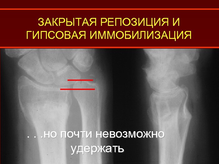 ЗАКРЫТАЯ РЕПОЗИЦИЯ И ГИПСОВАЯ ИММОБИЛИЗАЦИЯ . . . но почти невозможно удержать 