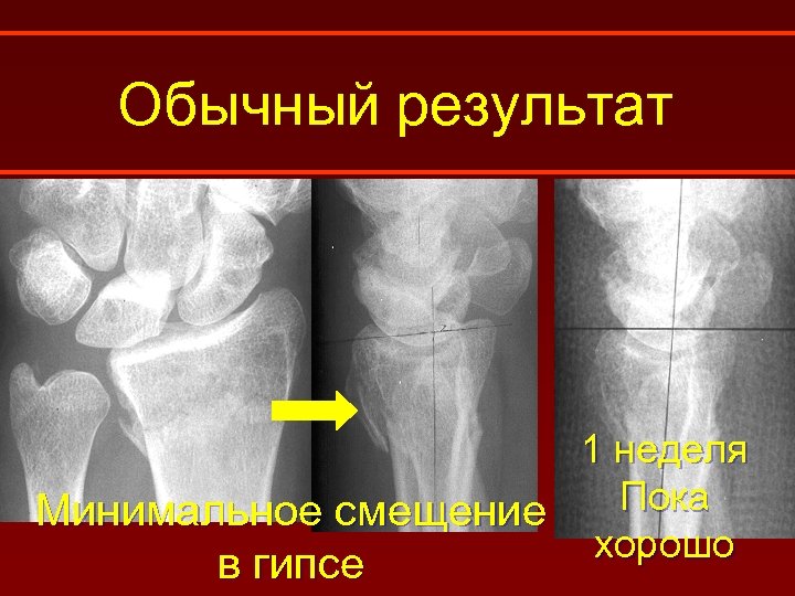 Обычный результат 1 неделя Пока Минимальное смещение хорошо в гипсе 