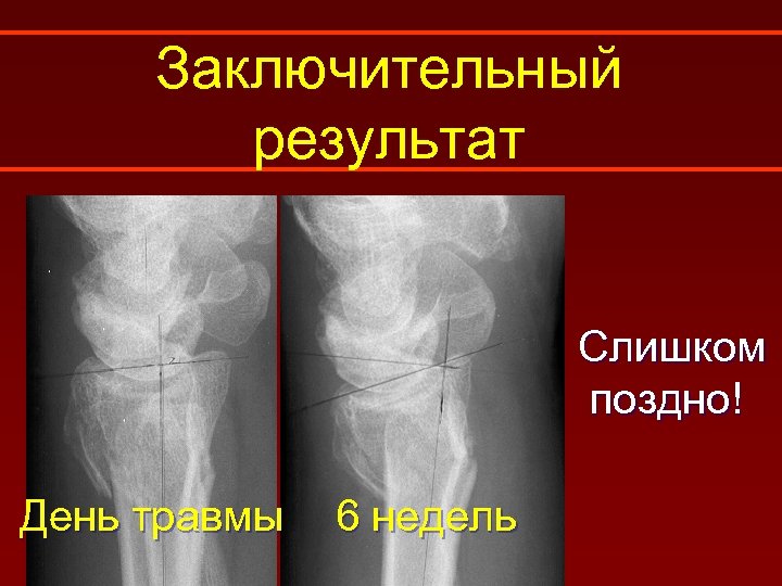 Заключительный результат Слишком поздно! День травмы 6 недель 