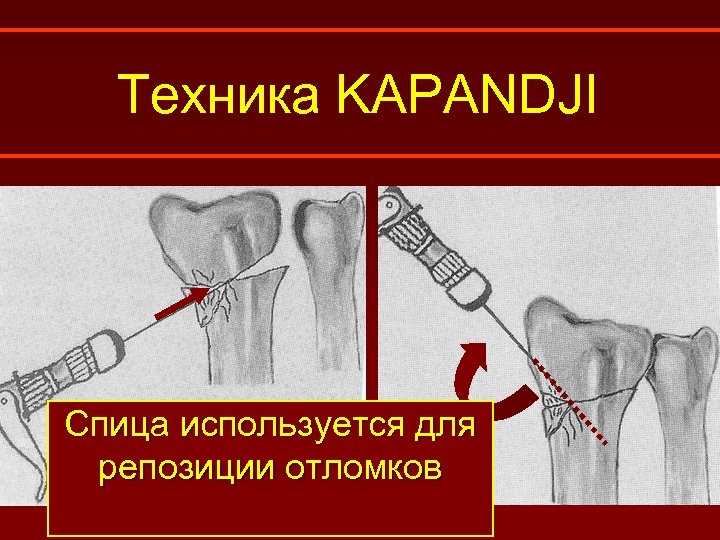 Техника KAPANDJI Спица используется для репозиции отломков 