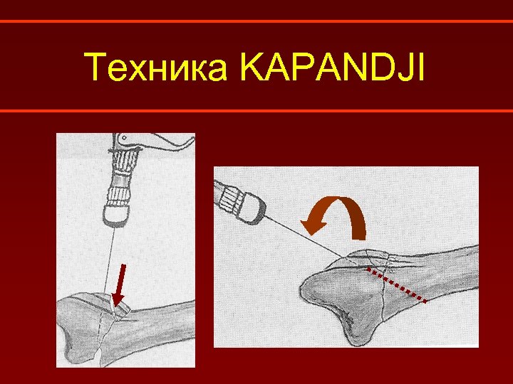 Техника KAPANDJI 