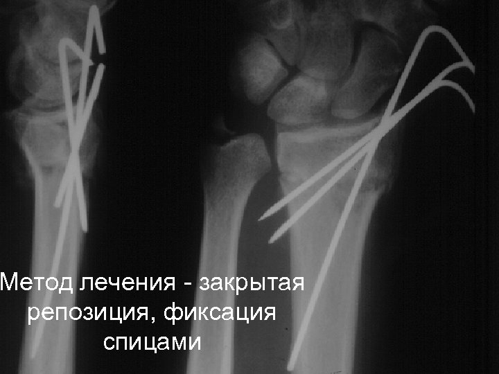 Метод лечения - закрытая репозиция, фиксация спицами 