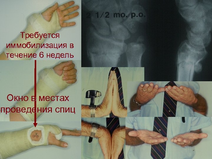 Требуется иммобилизация в течение 6 недель Окно в местах проведения спиц 