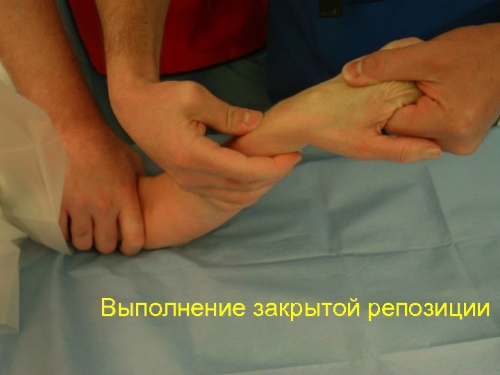 Выполнение закрытой репозиции 