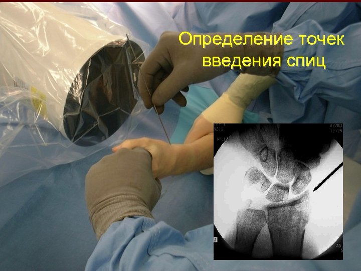 Определение точек введения спиц 