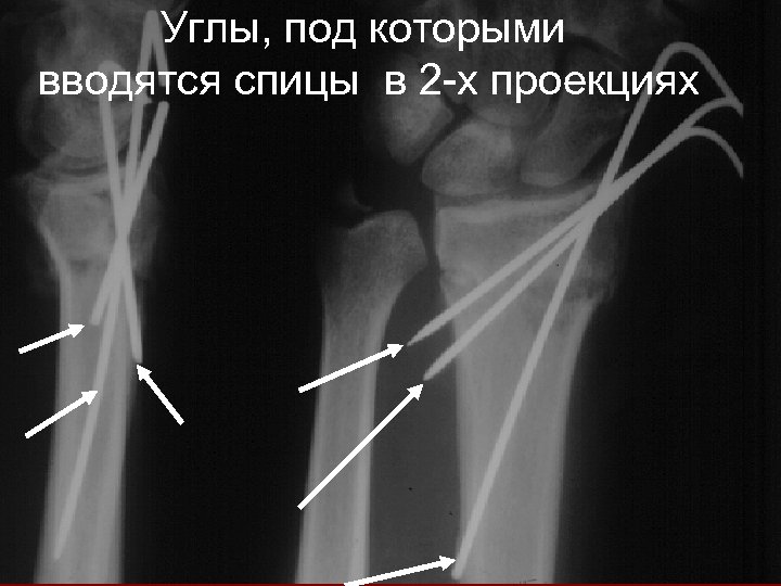 Углы, под которыми вводятся спицы в 2 -х проекциях 