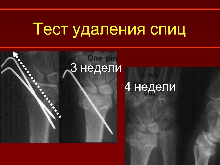 Тест удаления спиц 3 недели 4 недели 