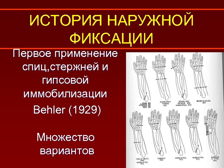 ИСТОРИЯ НАРУЖНОЙ ФИКСАЦИИ Первое применение спиц, стержней и гипсовой иммобилизации Behler (1929) Множество вариантов