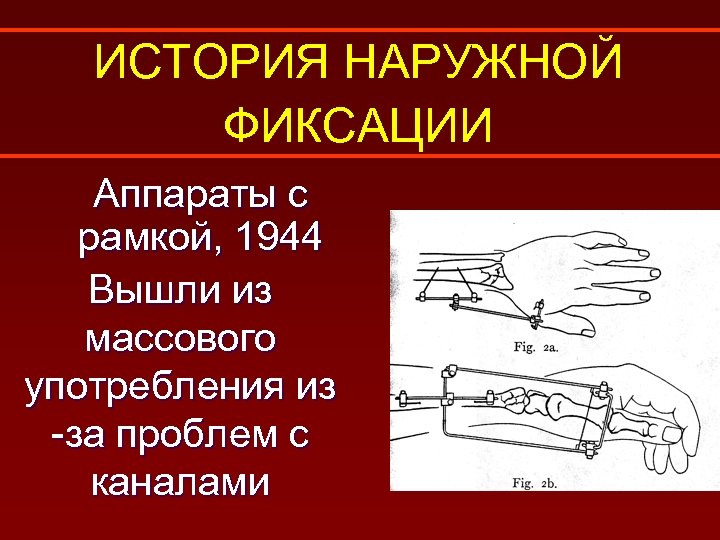 ИСТОРИЯ НАРУЖНОЙ ФИКСАЦИИ Аппараты с рамкой, 1944 Вышли из массового употребления из -за проблем