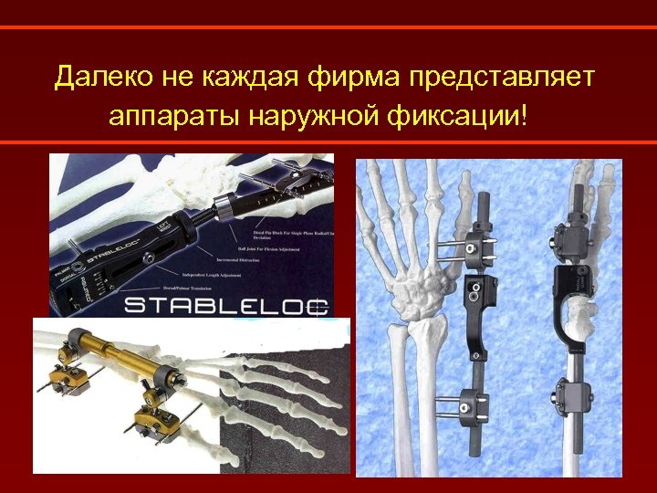 Далеко не каждая фирма представляет аппараты наружной фиксации! 