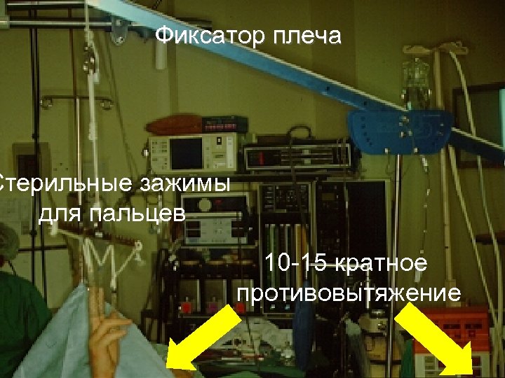 Фиксатор плеча Стерильные зажимы для пальцев 10 -15 кратное противовытяжение 