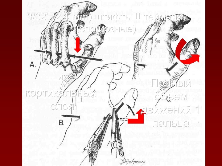 3/32” (2. 4 mm) штифты Штеймана (спогиозные) 4 кортикальных слоя Полный объем движений 1