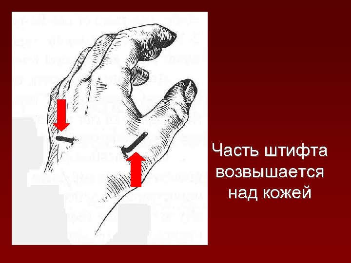 Часть штифта возвышается над кожей 