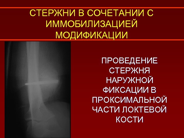 СТЕРЖНИ В СОЧЕТАНИИ С ИММОБИЛИЗАЦИЕЙ МОДИФИКАЦИИ ПРОВЕДЕНИЕ СТЕРЖНЯ НАРУЖНОЙ ФИКСАЦИИ В ПРОКСИМАЛЬНОЙ ЧАСТИ ЛОКТЕВОЙ