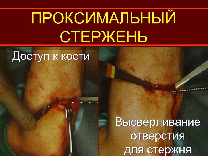 ПРОКСИМАЛЬНЫЙ СТЕРЖЕНЬ Доступ к кости Высверливание отверстия для стержня 