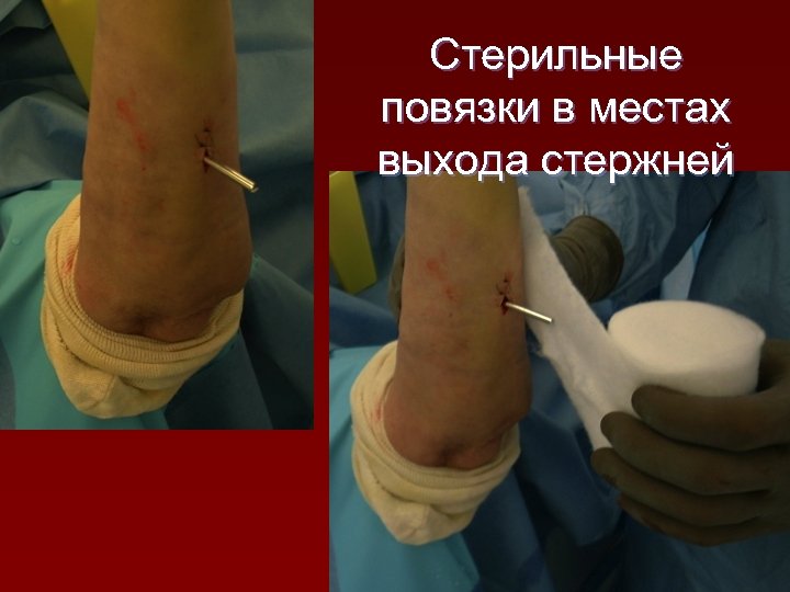 Стерильные повязки в местах выхода стержней 