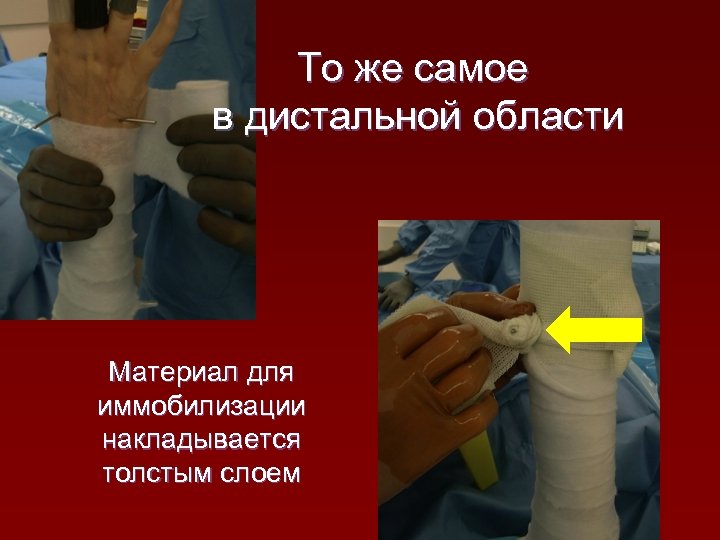 То же самое в дистальной области Материал для иммобилизации накладывается толстым слоем 