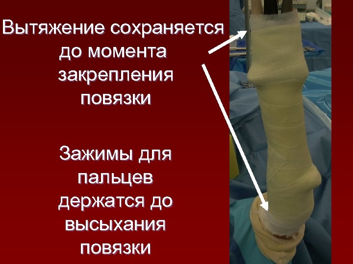 Вытяжение сохраняется до момента закрепления повязки Зажимы для пальцев держатся до высыхания повязки 