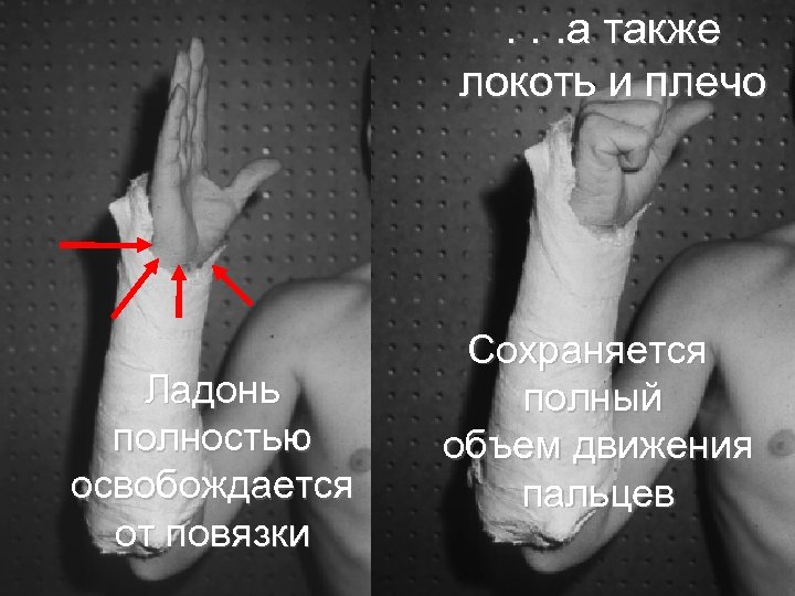 . . . а также локоть и плечо Ладонь полностью освобождается от повязки Сохраняется