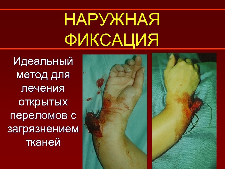 НАРУЖНАЯ ФИКСАЦИЯ Идеальный метод для лечения открытых переломов с загрязнением тканей 