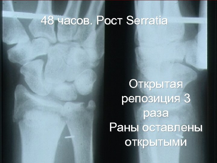 48 часов. Рост Serratia Открытая репозиция 3 раза Раны оставлены открытыми 