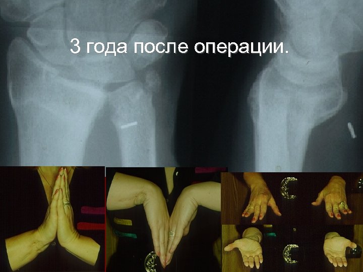 3 года после операции. 