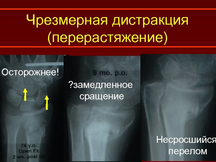 Чрезмерная дистракция (перерастяжение) Осторожнее! ? замедленное сращение Несросшийся перелом 
